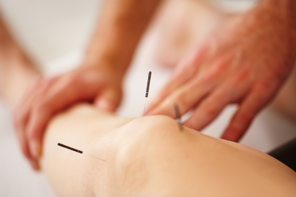 Periosteal Electric Dry Needling for Knee Osteoarthritis: Effectiveness & Mechanisms 1